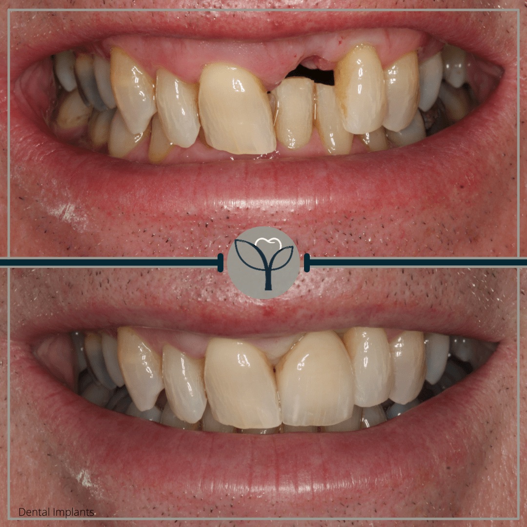 dental-implant-yor-dental-3